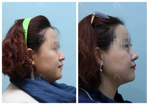 韩国爱护整形医院鼻子整形模板对比图