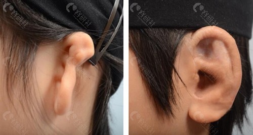 韩国profile普罗菲耳整形外科耳再造前后对比照