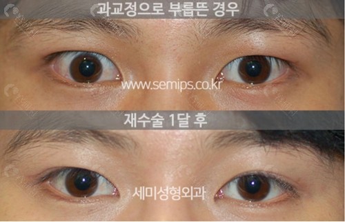 韩国眼部提肌修复对比照