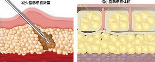 顾建成吸脂优势介绍