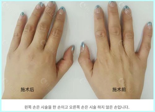 韩国JF皮肤科医院自体脂肪丰手背前后对比图片