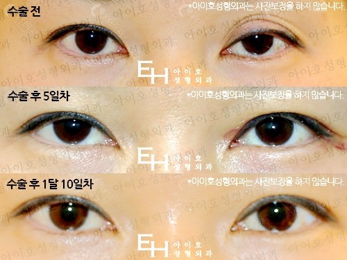 韩国爱护整形外科朴炳浩双眼皮不对称矫正前后对比照