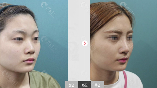 韩国赫拉整形外科鼻修复对比