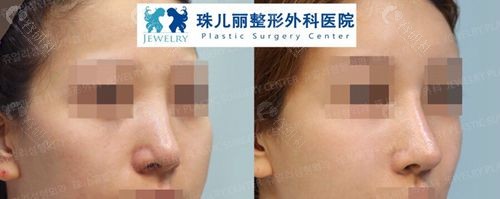 韩国珠儿丽整形外科鼻修复对比