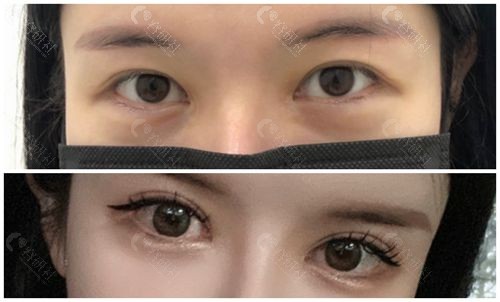 韩国可来熙整形外科眼修复对比