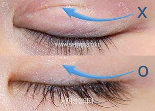 韩国世美整形外科双眼皮疤痕修复前后对比图