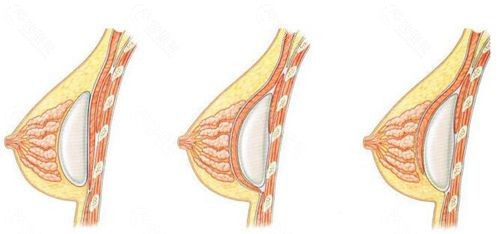 隆胸假体放置层次