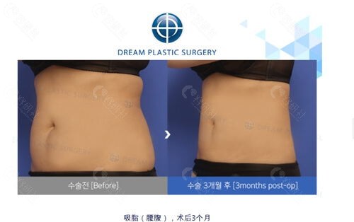 韩国梦想整形外科医院抽脂价格表