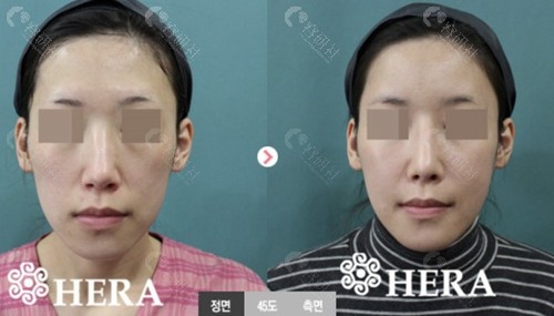 韩国赫拉整形医院隆鼻修复对比图