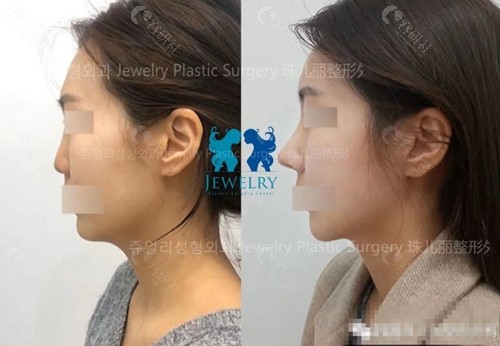 韩国珠儿丽整形外科隆鼻修复对比图