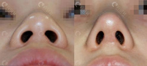 韩国伊美芝整形外科鼻头整形前后对比图片