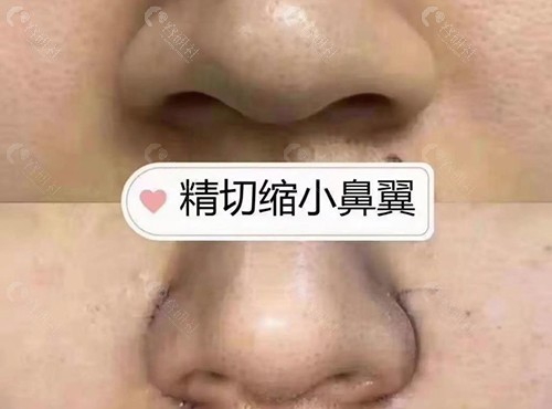 成都鼻翼缩小做得好的医生