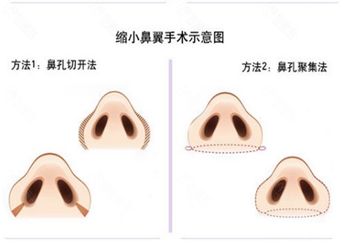 成都做鼻翼缩小价格