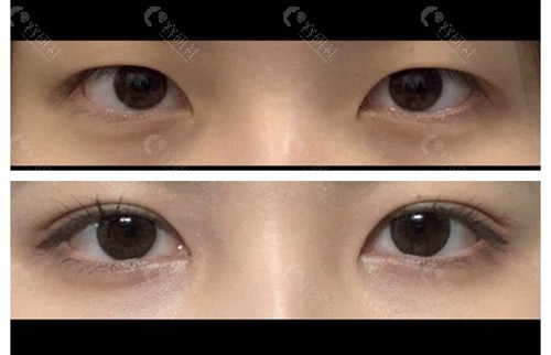 韩国EH爱护整形外科双眼皮提肌矫正图片