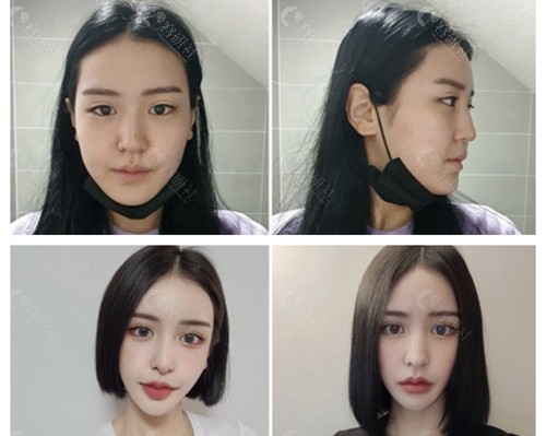 韩国ID整形医院双眼皮提肌矫正图片