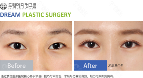 韩国梦想整形外科医院双眼皮提肌矫正图片