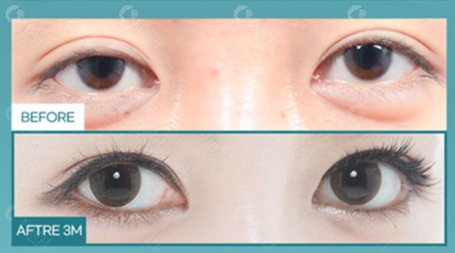 韩国普罗菲耳整形医院双眼皮提肌矫正图片