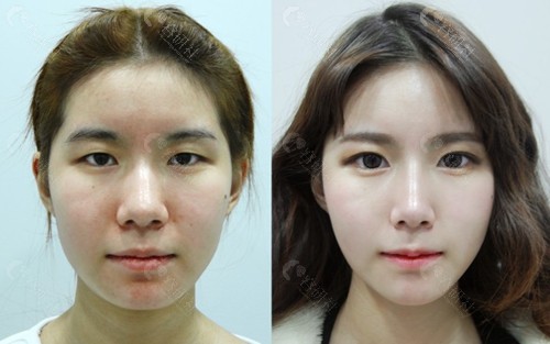韩国faceplus整形外科双眼皮提肌矫正图片