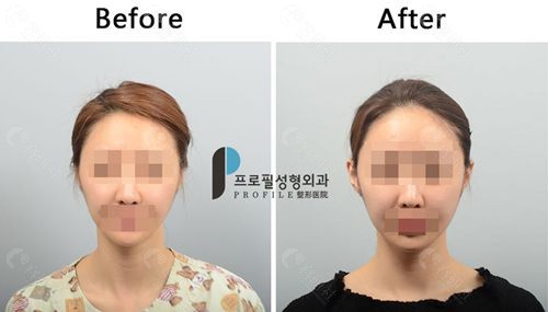 韩国普罗菲耳整形医院贴发耳矫正对比