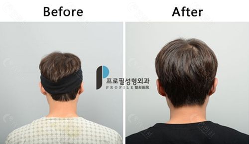 韩国普罗菲耳整形医院贴发耳矫正前后对比