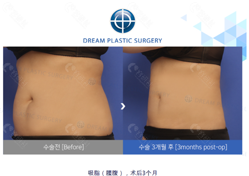 韩国梦想整形外科医院腰腹吸脂对比图