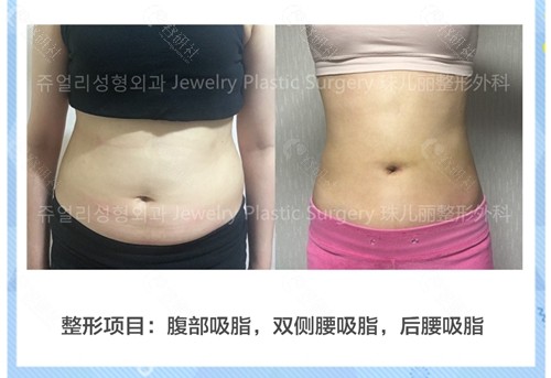 韩国珠儿丽整形外科腰腹吸脂对比图