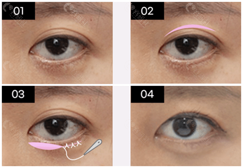 韩国来丽整形外科眼睑外翻矫正方法