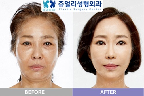 韩国珠儿丽整形外科拉皮手术实例