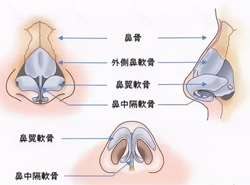 鼻软骨隆鼻