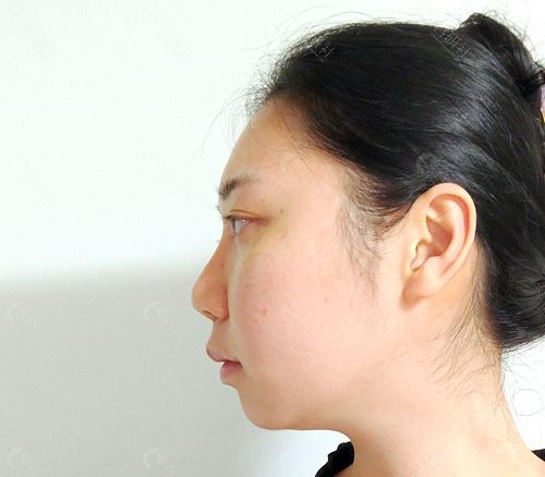 韩国优雅人整形外科鼻修复手术前图片