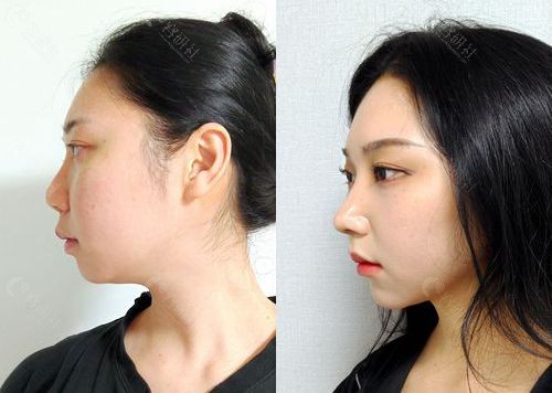 韩国优雅人整形外科歪鼻矫正修复手术前后对比照