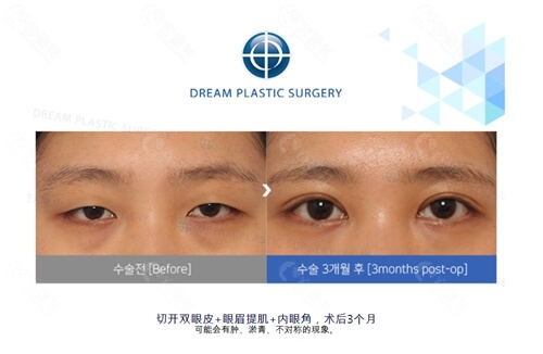 韩国梦想整形外科医院做眼睛修复好吗