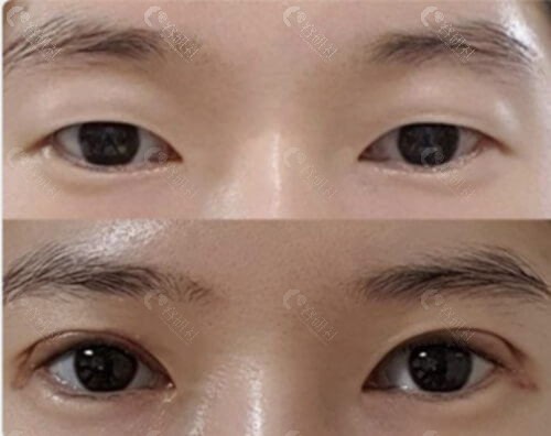 韩国爱护整形医院双眼皮对比照