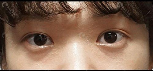 韩国原辰整形外科天使眼手术后照片