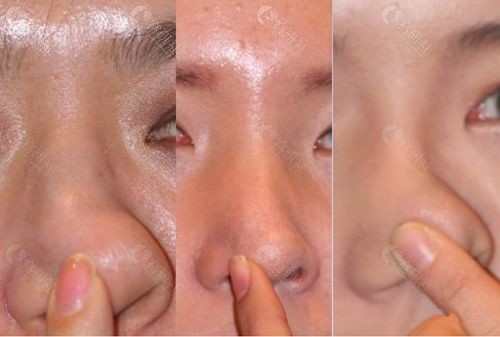 韩国赫拉整形外科代表院长李丙玟“立体旋翼鼻修复”术后可以做猪鼻子