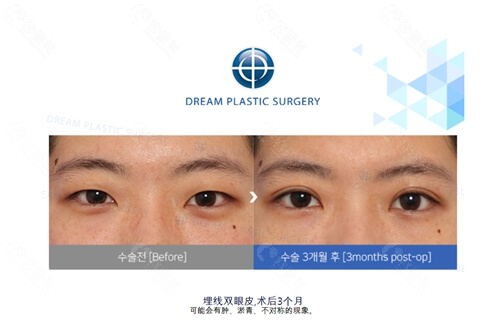 韩国梦想整形外科医院眼鼻手术对比照
