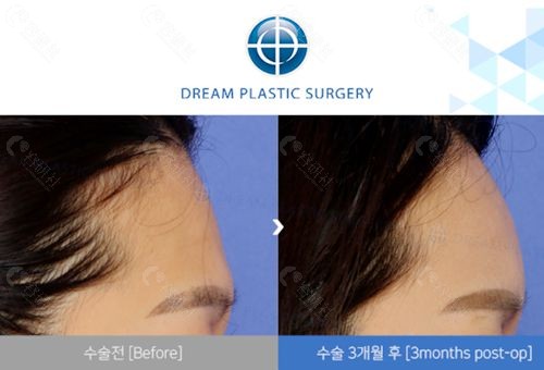 韩国梦想整形外科柳垣在自体脂肪填充额头前后对比照