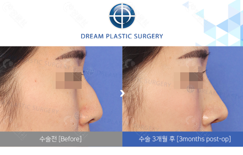 韩国梦想整形外科医院隆鼻修复对比图
