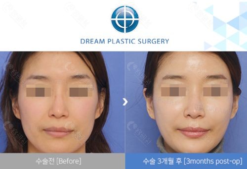 韩国梦想整形外科全脸脂肪填充前后对比图
