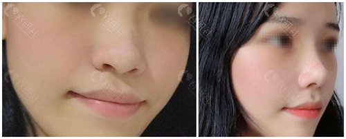 韩国来丽整形外科鼻修复对比