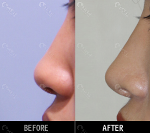 韩国爱护整形医院鼻修复对比