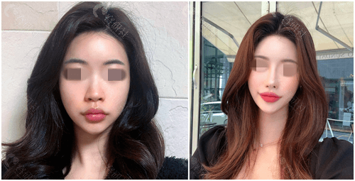 韩国优雅人整形外科鼻修复对比