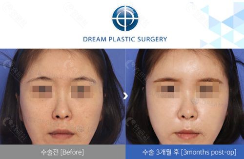 韩国梦想整形外科自体脂肪填充额头+法令纹前后对比图