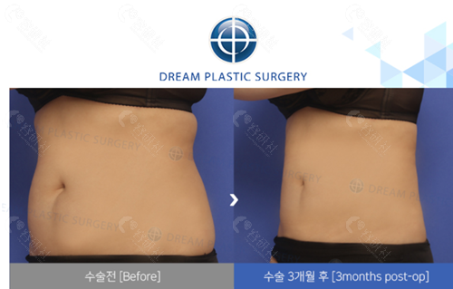 韩国梦想整形外科医院腰腹吸脂对比图