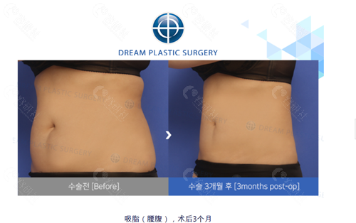 韩国梦想整形外科医院腰腹吸脂对比照