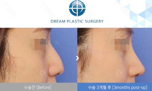 韩国Dream整形外科鹰钩鼻手术矫正前后图片