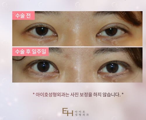 韩国爱护整形医院双眼皮修复对比照
