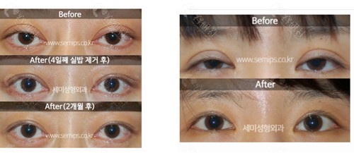 韩国世美整形外科双眼皮修复