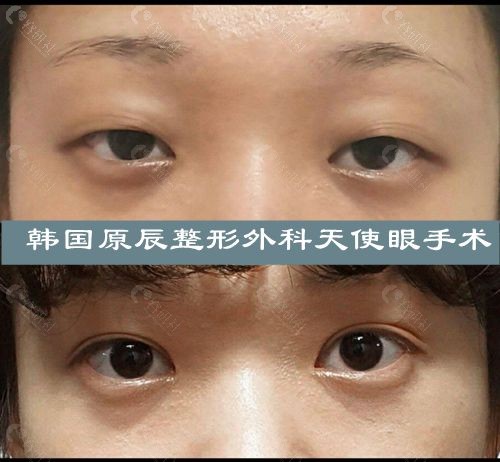 韩国原辰整形外科朴章佑天使眼手术前后对比照