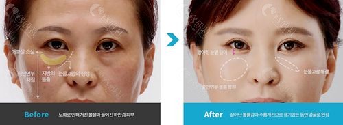 韩国大眼睛高汉雄有立体感的眼袋提拉手术后的对比图正面